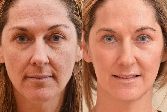 Rajeunissement du visage avant et après