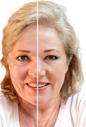 Rajeunissement du visage