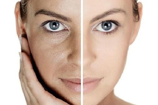 Sonner la peau avec leur propre plasma sanguin