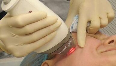 Comment se déroule le rajeunissement fractionné de la peau 