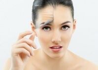 Fille après rajeunissement du visage au laser fractionné