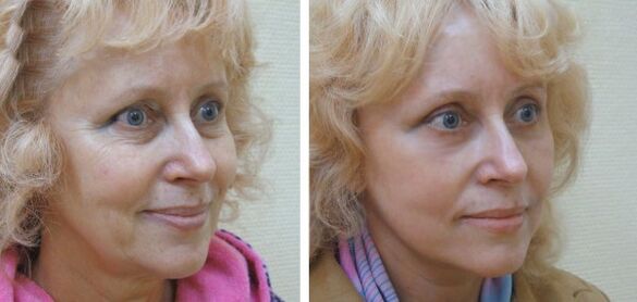 Femme avant et après le rajeunissement de la peau du visage au plasma