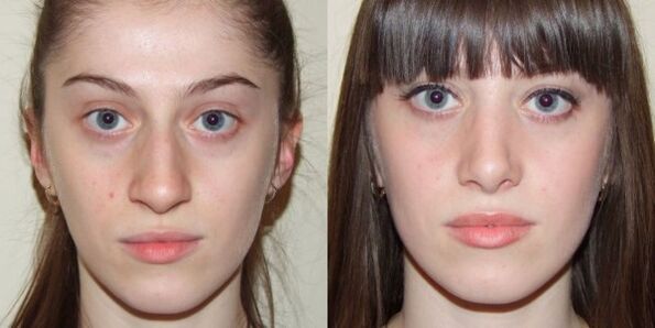 Fille avant et après le rajeunissement de la peau du visage au plasma
